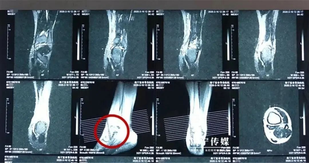 脚踝处有大量积液